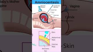 Amniocentesis amniocentesis kya hota h amniocentesis NEETUG Nursing pregnancy childbirth [upl. by Seabrooke]