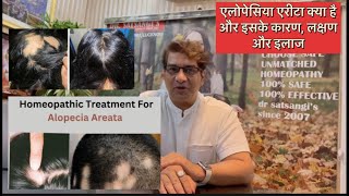 Alopecia Areata Diagnosis Treatment  Curing Bald patch  Why Homeopathy Hair Treatment Dr Satsangi [upl. by Metzger214]