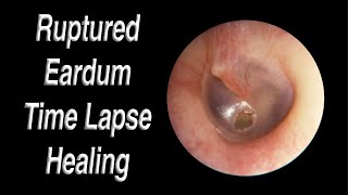 Ruptured Eardrum Healing Closed Time Lapse  A Hole in Eardrum Usually Heals Closed on Its Own [upl. by Mellisa]