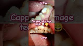 Capping on Damaged Teeth 🦷😏bdshorts dental teethwhitening teeth smile [upl. by Felecia]