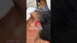 Laser treatment for hyperpigmentation oddlysatisfying hyperpigmentation [upl. by Sprung]