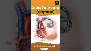 Cardiac Dysrhythmias Arrhythmia Part1  Types of Cardiac Arrhythmia Cardiac Dysrhythmias [upl. by Anivek957]