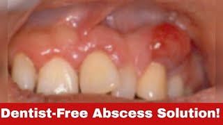 5 Simple Tricks How to Get Rid of a Tooth Abscess Without Going to the Dentist [upl. by Atinoj917]