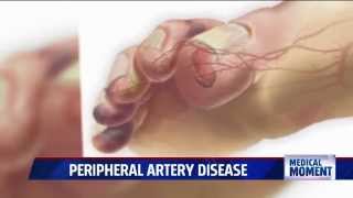 Symptoms and Treatments for Peripheral Artery Disease PAD [upl. by Aicrag]