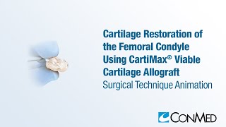 Cartilage Restoration of the Femoral Condyle Using CartiMax®  CONMED Animation [upl. by Manard]