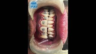 Class 2 div 1 Malocclusion  BRACES trending dentist toothdental dentalcare dentalclinic tooth [upl. by Nosreve]