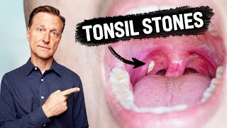 What CAUSES Tonsil Stones and How to Prevent Them [upl. by Pas]