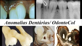 ANOMALIAS DENTÁRIAS  PATOLOGIA BUCAL [upl. by Boylston]