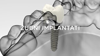 Ugradnja implantata u slučaju vađenja zuba Case study by dr Filip Štimac [upl. by Gaynor]