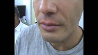 Acupuncture For Lip Augmentation [upl. by Nary]