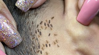 How Head Lice Removed By Hand  Head Lice Removing All From Black Hair 15 [upl. by Waylon615]