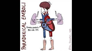 Embolic Events Stroke vs PE vs Paradoxical Emboli [upl. by Gorman]