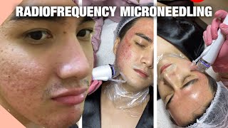 BYE ACNE SCARS BYE WRINKLES  ENVI NOVELLUS RADIOFREQUENCY MICRONEEDLING  PRP REJUVE [upl. by Gar]