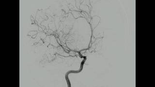 Arteriografia Cerebral Normal [upl. by Gnivri]