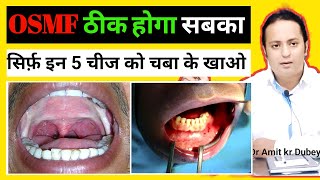 OSMF Treatments in Ayurvedic  5 Ayurvedic उपचार । dramitkdubey [upl. by Lletnwahs]