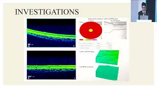 AIOC2024 GP199 topic Dr Markandeya Singh Foveal Aplasia [upl. by Enilhtak633]