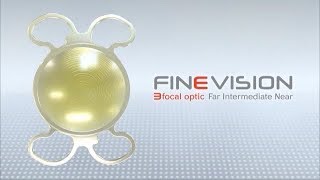 FineVision Trifocal Intraocular Lens [upl. by Ykcaj]