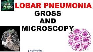 Lobar Pneumonia  Pathology  Gross and Microscopy  Illustration  Draw With Me [upl. by Mukul470]