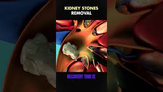 KIDNEY STONES REMOVAL TREATMENT 3D VIDEO [upl. by Esimorp]