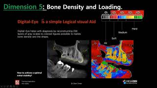 1 Assessing Bone density using Hounsfield units vs Digital eye [upl. by Nedyrb]