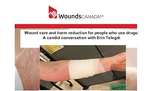 Webinar Presentation Wound Care and Harm Reduction in People Who Use Drugs [upl. by Bibbye]