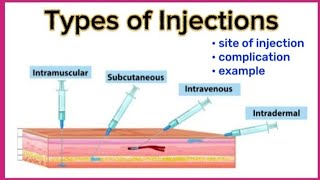 Types of injection and their site  Intravenous Intramuscular Intradermal Subcutaneous [upl. by Asirem]