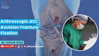 Arthroscopic ACL Avulsion Fracture Fixation [upl. by Mohorva924]