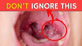 Tonsil Stones – Removing the Deeper Cause [upl. by Selyn107]