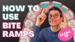 How and when to use Invisalign clear aligners bite ramps [upl. by Triley108]