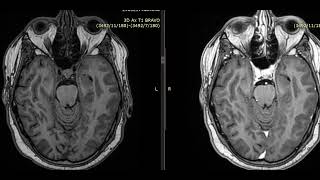 case 19 52 year male from ICU subacute infarct mimic neoplasm [upl. by Simetra505]