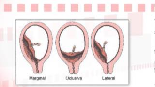 Dr Ignacio Pérez Tomasone ¿Qué es la placenta previa [upl. by Artima547]