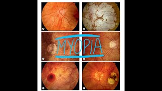 Pathological MyopiaDegenerative Myopia [upl. by Nwahsyar]