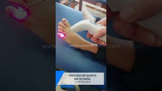 Tratamento conservador  Laserterapia  Fratura no quinto metatarso [upl. by Ial]