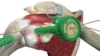 Biceptor Tenodesis System  Surgical Technique Walkthrough  SIMON MOYES [upl. by Emirej841]