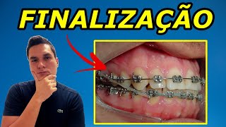 FINALIZAÇÃO DO TRATAMENTO ORTODÔNTICO  COMO FUNCIONA ESSA FASE  O QUE O DENTISTA USA [upl. by Fredette927]