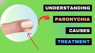 Paronychia Explained How to Spot Treat and Prevent Nail Infections  SWOLLEN TISSUE around Nails [upl. by Thacher]