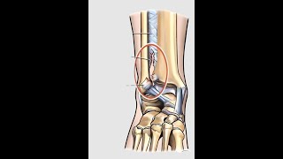 Surgical Treatment for Syndesmotic Instability [upl. by Shih614]