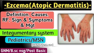 Eczema  Atopic Dermatitis lecture in Hindi [upl. by Felske]