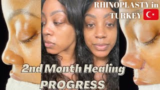 ETHNIC RHINOPLASTY in TURKEY 🇹🇷  2nd Month Healing Progress  NO MAKEUP [upl. by Freudberg]