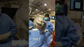 Live Kidney AML Angiomyolipoma Embolization Treatment Doctor [upl. by Adnaluoy838]