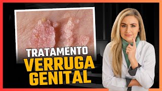 Tratamento para VERRUGA GENITAL [upl. by Ecinnahs63]