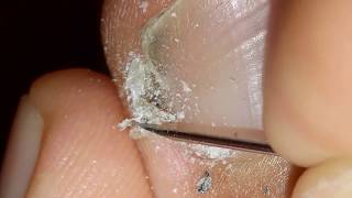 How to clean in depth lateral toenail fold 10 [upl. by Casimire]