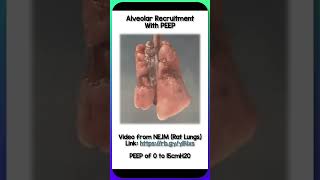 Alveolar Recruitment with PEEP REBELEM PEEP Alveoli Lungs Intubation [upl. by Hoffert]