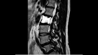 rare case of hemangioma L2 L3 [upl. by Natam64]