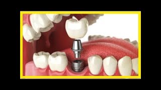 Implantes dentários consideração a respeito da substituição de um dente permanente [upl. by Sueahccaz]