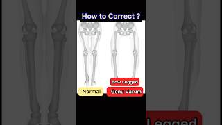 Bow Legs Correction Genu Varum Exercise [upl. by Anali164]