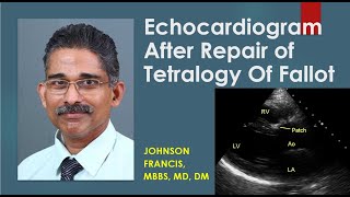 Echocardiogram After Repair of Tetralogy Of Fallot [upl. by Lenni255]