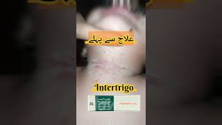 IntertrigoFungal infection of skin folds Pediatrics dermatology [upl. by Adriell456]