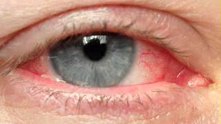 Eye cancer symptoms [upl. by Leander710]