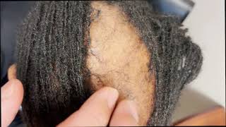 AfricanAmerican Hair Loss Traction Alopecia No [upl. by Aksel775]